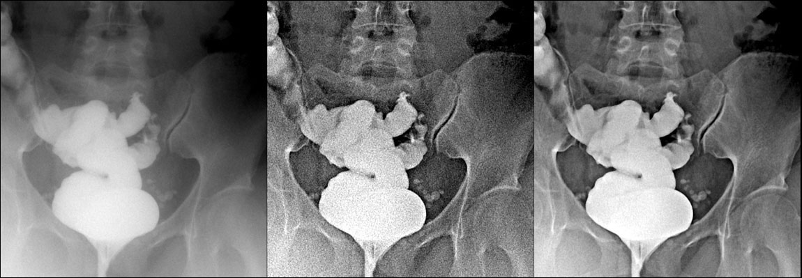 pelvis coronal contrast